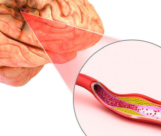 Non-Surgical Options: How to Remove a Blood Clot in the Brain